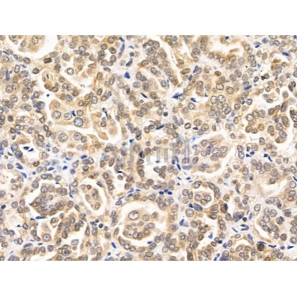 RECQL5 Antibody - DF13664 at 1/100 staining Human kidney cancer by IHC-P.