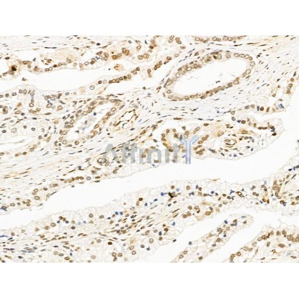 RECQL5 Antibody - DF13664 at 1/100 staining Human colorectal cancer by IHC-P.