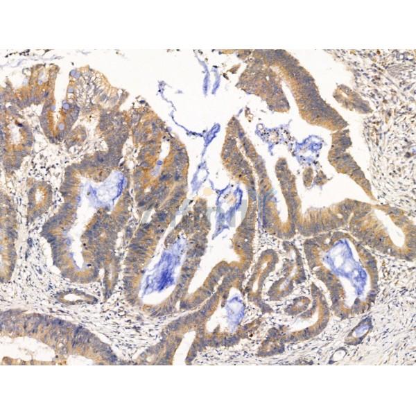Dhh Antibody - DF13675 at 1/100 staining Human colorectal cancer by IHC-P.