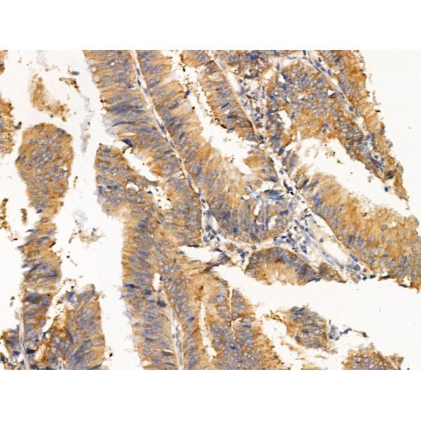 Dhh Antibody - DF13675 at 1/100 staining Human colorectal cancer by IHC-P.