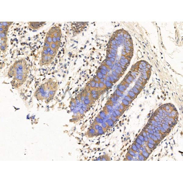 Dhh Antibody - DF13675 at 1/100 staining Human colorectal cancer and adjacent normal tissues by IHC-P.