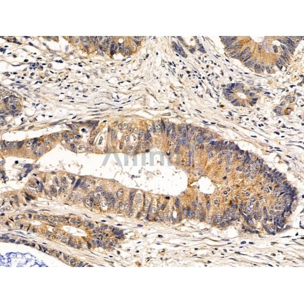 SDCCAG3 Antibody - DF13676 at 1/100 staining Human colorectal cancer by IHC-P.