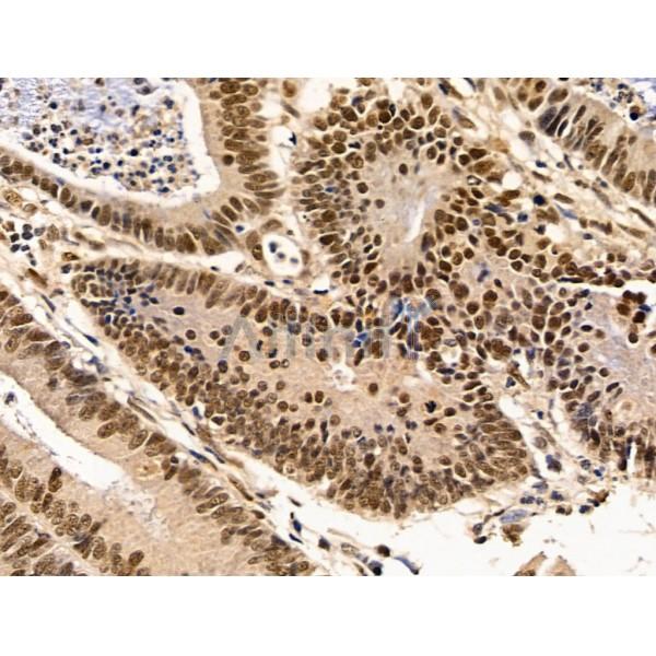 Importin 7 Antibody - DF13679 at 1/100 staining Human colorectal cancer and adjacent normal tissues by IHC-P.