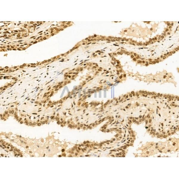 Importin 7 Antibody - DF13679 at 1/100 staining Human colorectal cancer by IHC-P.