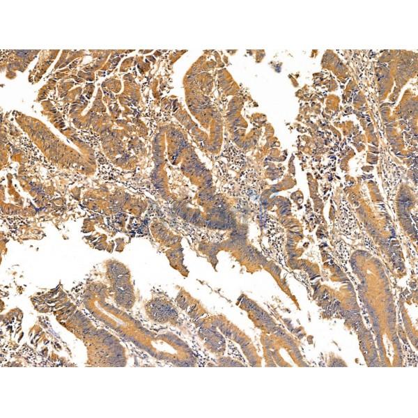 Zfp281 Antibody - DF13689 at 1/100 staining Human colorectal cancer and adjacent normal tissues by IHC-P.