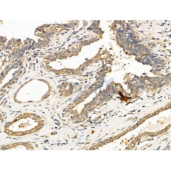 HOXA4 Antibody - DF13701 at 1/100 staining Human colorectal cancer by IHC-P.