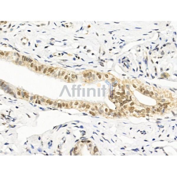 Hyaluronan synthase 2 Antibody - DF13702 at 1/100 staining Human kidney cancer by IHC-P.