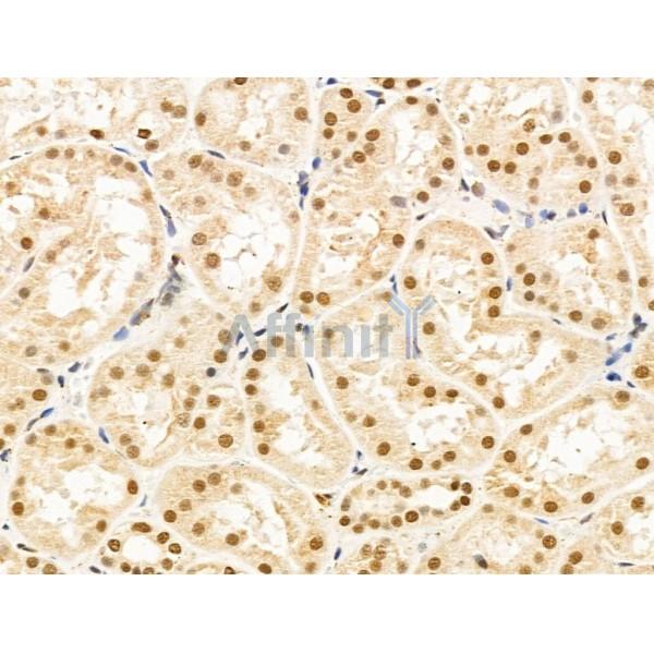 Hyaluronan synthase 2 Antibody - DF13702 at 1/100 staining Human kidney cancer and adjacent normal tissues by IHC-P.