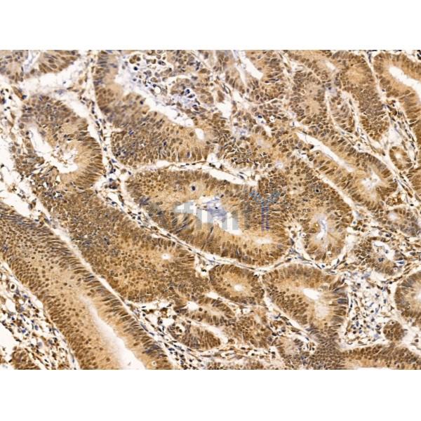 Hyaluronan synthase 2 Antibody - DF13702 at 1/100 staining Human colorectal cancer by IHC-P.