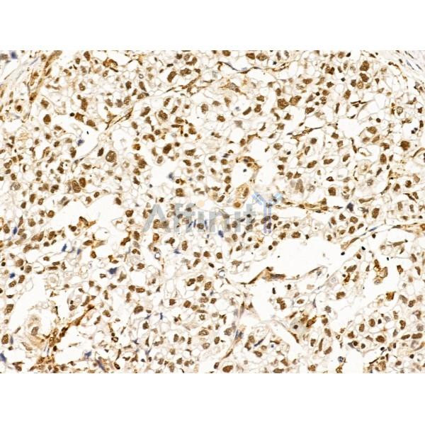 Hyaluronan synthase 2 Antibody - DF13702 at 1/100 staining Human pancreatic cancer by IHC-P.