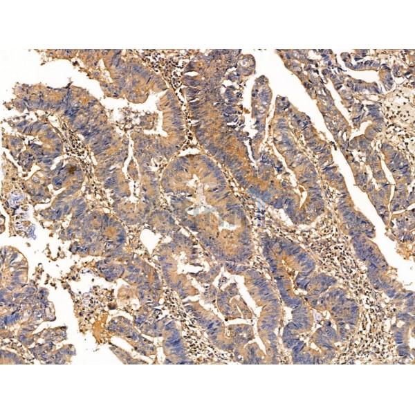 TCTEX1D2 Antibody - DF13706 at 1/100 staining Human colorectal cancer and adjacent normal tissues by IHC-P.
