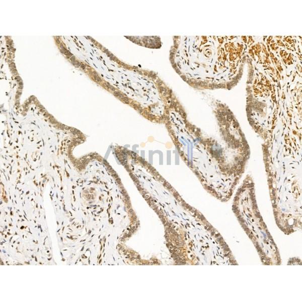 CCDC28A Antibody - DF13712 at 1/100 staining Human kidney cancer by IHC-P.