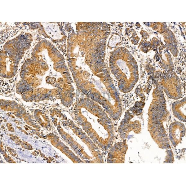 Methylmalonyl Coenzyme A mutase Antibody - DF13718 at 1/100 staining Human colorectal cancer and adjacent normal tissues by IHC-P.