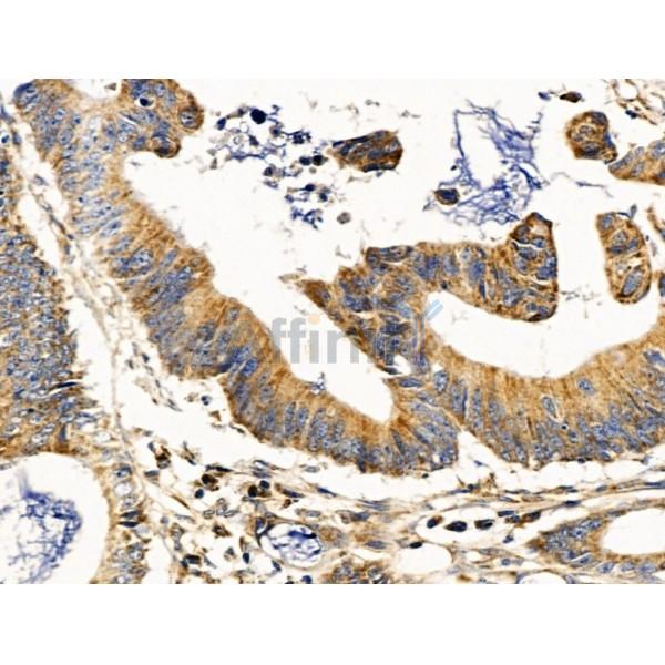 Methylmalonyl Coenzyme A mutase Antibody - DF13718 at 1/100 staining Human colorectal cancer by IHC-P.
