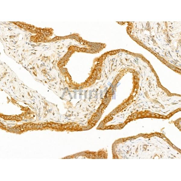GCHFR Antibody - DF13726 at 1/100 staining Human ovarian cancer and adjacent normal tissues by IHC-P.