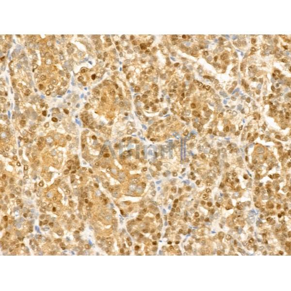 GCHFR Antibody - DF13726 at 1/100 staining Human kidney cancer by IHC-P.