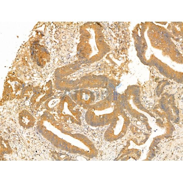 GCHFR Antibody - DF13726 at 1/100 staining Human colorectal cancer by IHC-P.