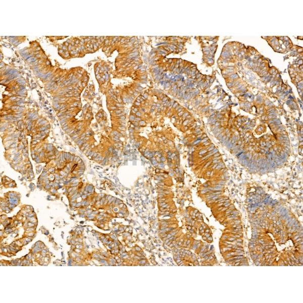 SCAMP2 Antibody - DF13731 at 1/100 staining Human colorectal cancer and adjacent normal tissues by IHC-P.