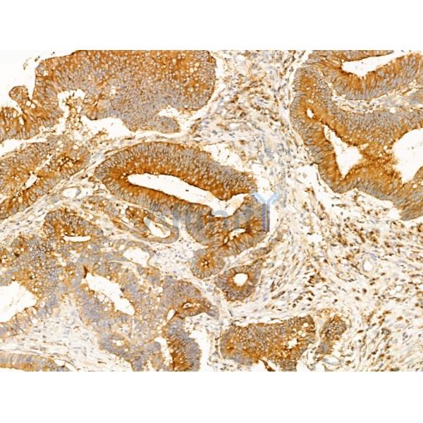 SCAMP2 Antibody - DF13731 at 1/100 staining Human colorectal cancer by IHC-P.