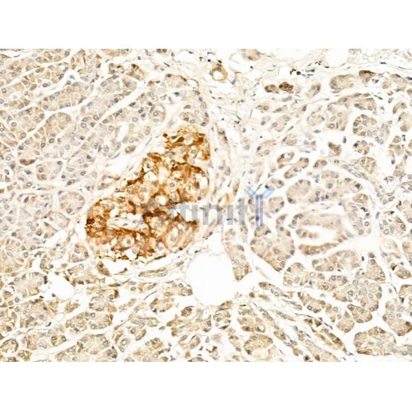 GPR19 Antibody - DF2729 at 1/100 staining Human pancreatic cancer and adjacent nomal tissues by IHC-P.