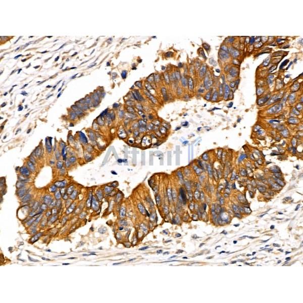 Cytokeratin 20 Antibody - AF0193 at 1/100 staining Human colorectal cancer by IHC-P.