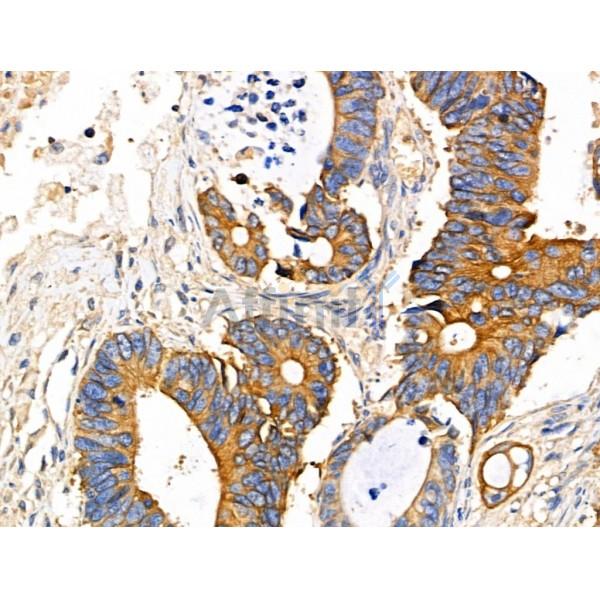 Cytokeratin 20 Antibody - AF0193 at 1/100 staining Human colorectal cancer by IHC-P.