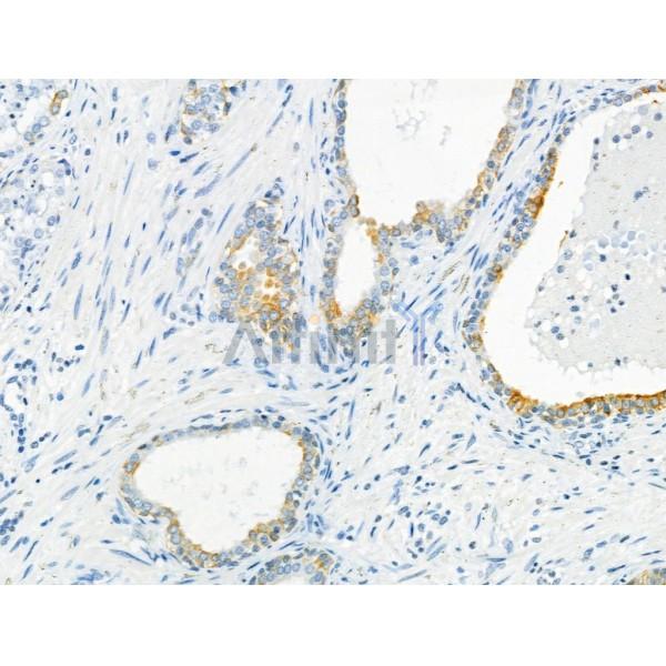 Cytokeratin 7 Antibody - AF0195 at 1/100 staining human ovarian cancer by IHC-P.
