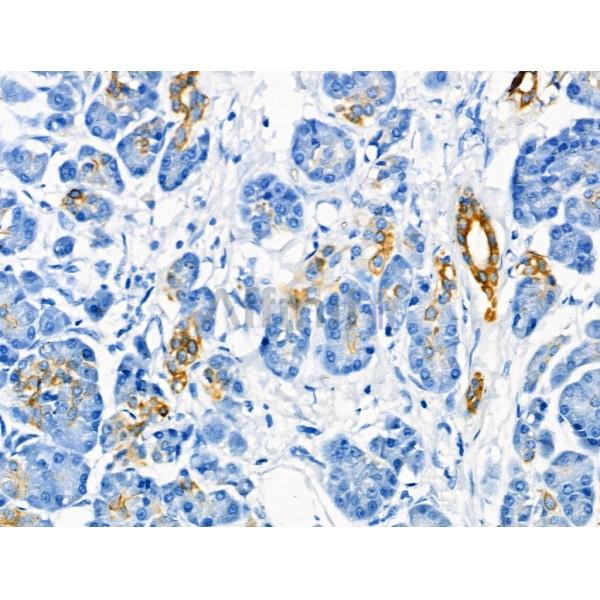 Cytokeratin 7 Antibody - AF0195 at 1/100 staining Human pancreatic cancer and adjacent nomal tissues by IHC-P.