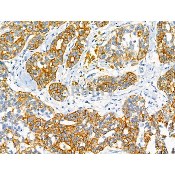 Cytokeratin 7 Antibody - AF0195 at 1/100 staining Human ovarian cancer by IHC-P.