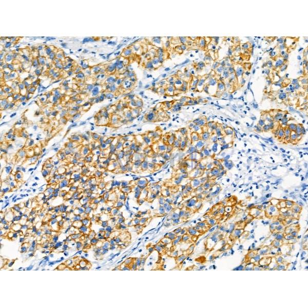 Cytokeratin 7 Antibody - AF0195 at 1/100 staining Human pancreatic cancer by IHC-P.