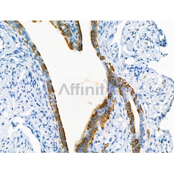 Cytokeratin 7 Antibody - AF0195 at 1/100 staining Human ovarian cancer and adjacent normal tissues by IHC-P.
