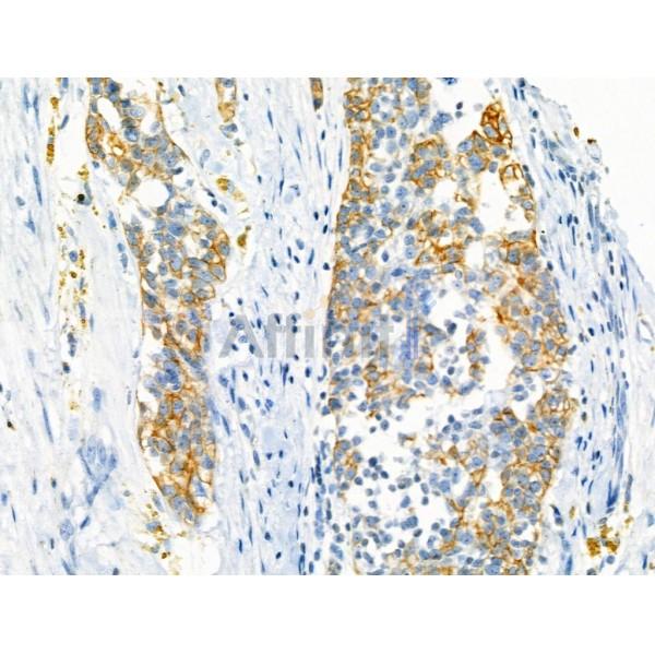 Cytokeratin 7 Antibody - AF0195 at 1/100 staining Human ovarian cancer by IHC-P.