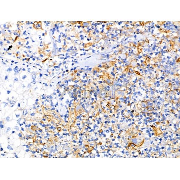 Mammaglobin B Antibody - AF0203 at 1/100 staining Human pancreatic cancer by IHC-P.