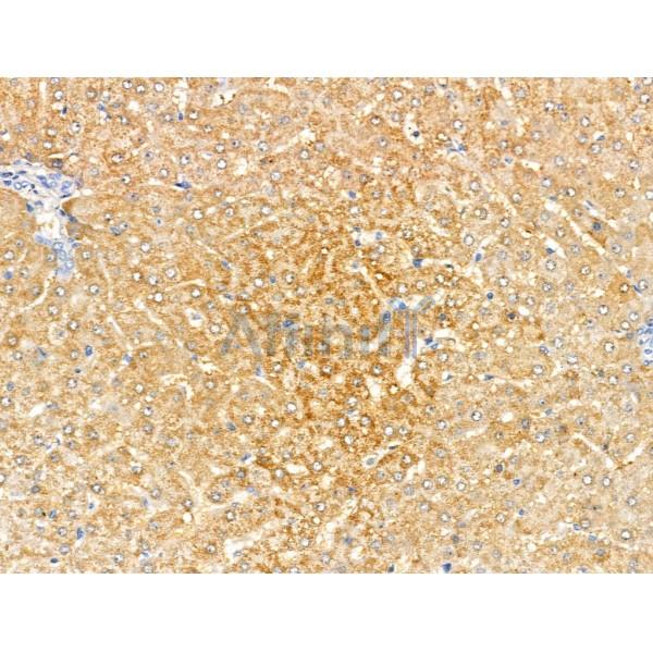 MMP8 Antibody - AF0219 at 1/100 staining Human liver cancer and adjacent normal tissues by IHC-P.