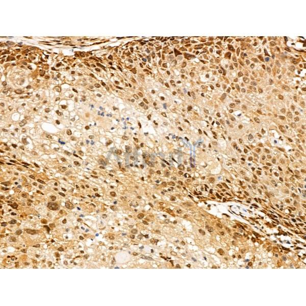 SENP8 Antibody - AF0279 at 1/100 staining Human ovarian cancer by IHC-P.