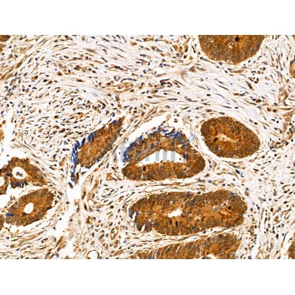 SENP8 Antibody - AF0279 at 1/100 staining Human colorectal cancer by IHC-P.