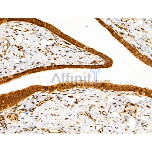 SENP8 Antibody - AF0279 at 1/100 staining Human ovarian cancer and adjacent normal tissues by IHC-P.