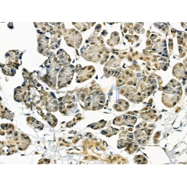 AKAP8 Antibody - AF0333 at 1/100 staining Human pancreatic cancer and adjacent nomal tissues by IHC-P.