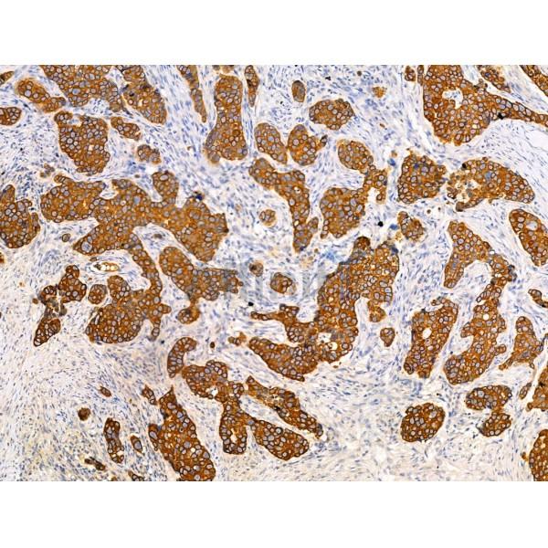 TRIM16 Antibody - AF0352 at 1/100 staining Human mammary cancer and adjacent normal tissues by IHC-P.
