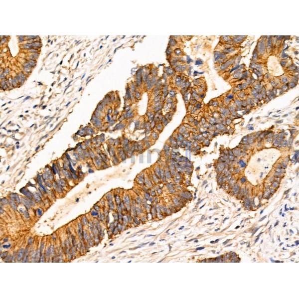 TRIM16 Antibody - AF0352 at 1/100 staining Human colorectal cancer by IHC-P.