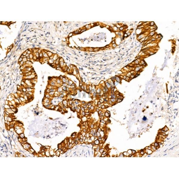 TRIM16 Antibody - AF0352 at 1/100 staining Human lung cancer by IHC-P.