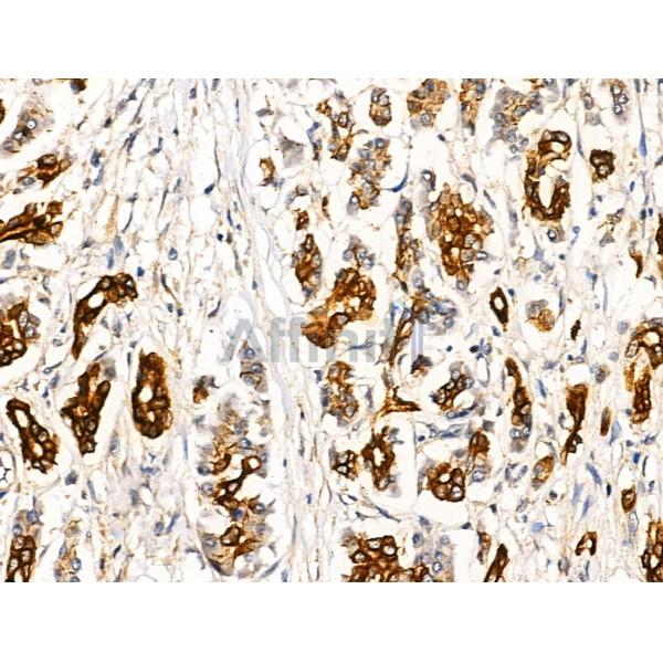 TRIM16 Antibody - AF0352 at 1/100 staining Human pancreatic cancer and adjacent nomal tissues by IHC-P.