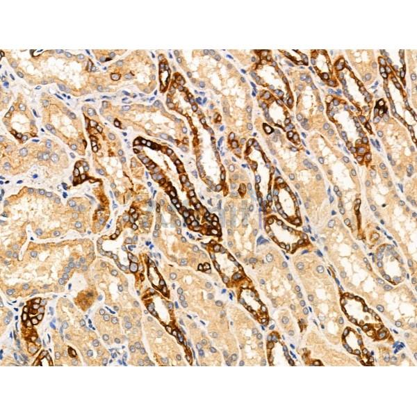 TRIM16 Antibody - AF0352 at 1/100 staining Human kidney cancer and adjacent normal tissues by IHC-P.