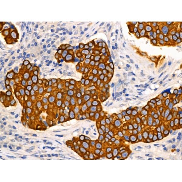 TRIM16 Antibody - AF0352 at 1/100 staining Human mammary cancer by IHC-P.