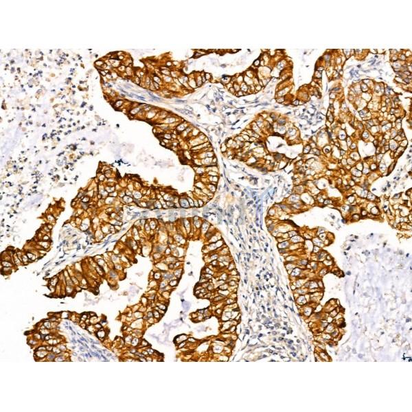 TRIM16 Antibody - AF0352 at 1/100 staining Human lung cancer by IHC-P.