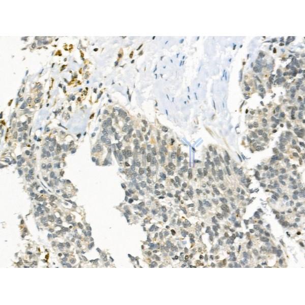 PKCB1 Antibody - AF0502 at 1/100 staining human ovarian cancer by IHC-P.