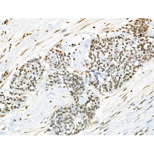 VPS72 Antibody - AF0508 at 1/100 staining Human ovarian cancer by IHC-P.