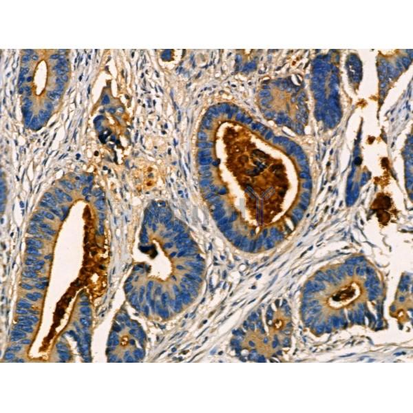 AKAP3 Antibody - AF0529 at 1/100 staining Human colorectal cancer by IHC-P.