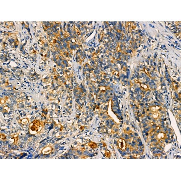AKAP3 Antibody - AF0529 at 1/100 staining Human gastric cancer by IHC-P.