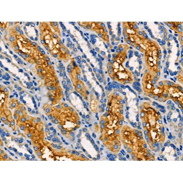 AKAP3 Antibody - AF0529 at 1/100 staining Human kidney cancer and adjacent normal tissues by IHC-P.